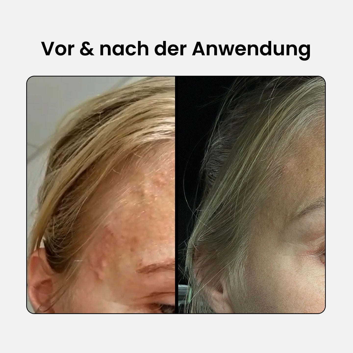 BHA-Set: Reiniger + Serum + Lotion + Körperspray