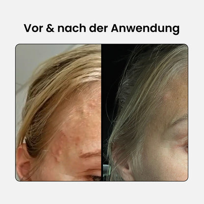 BHA-Set: Reiniger + Serum + Lotion + Körperspray