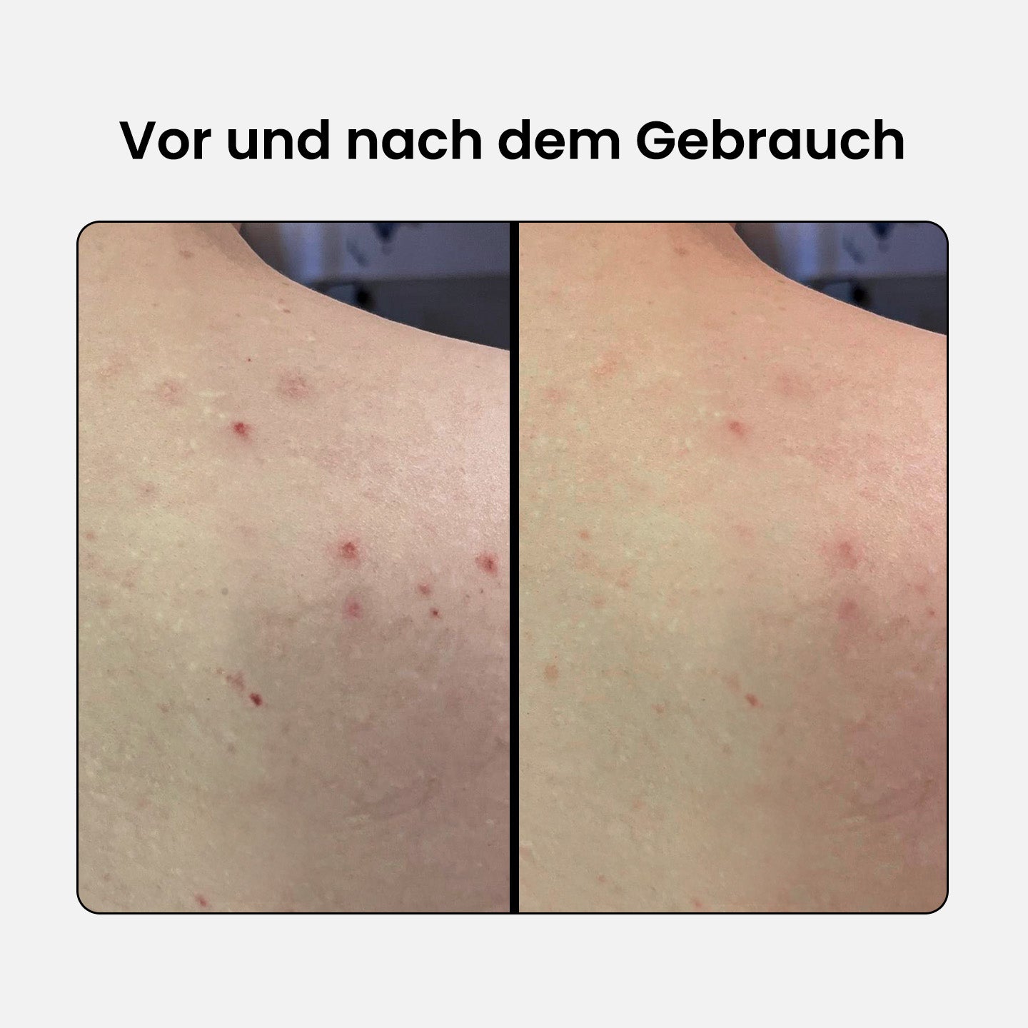 BHA-Set: Reiniger + Serum + Lotion + Körperspray