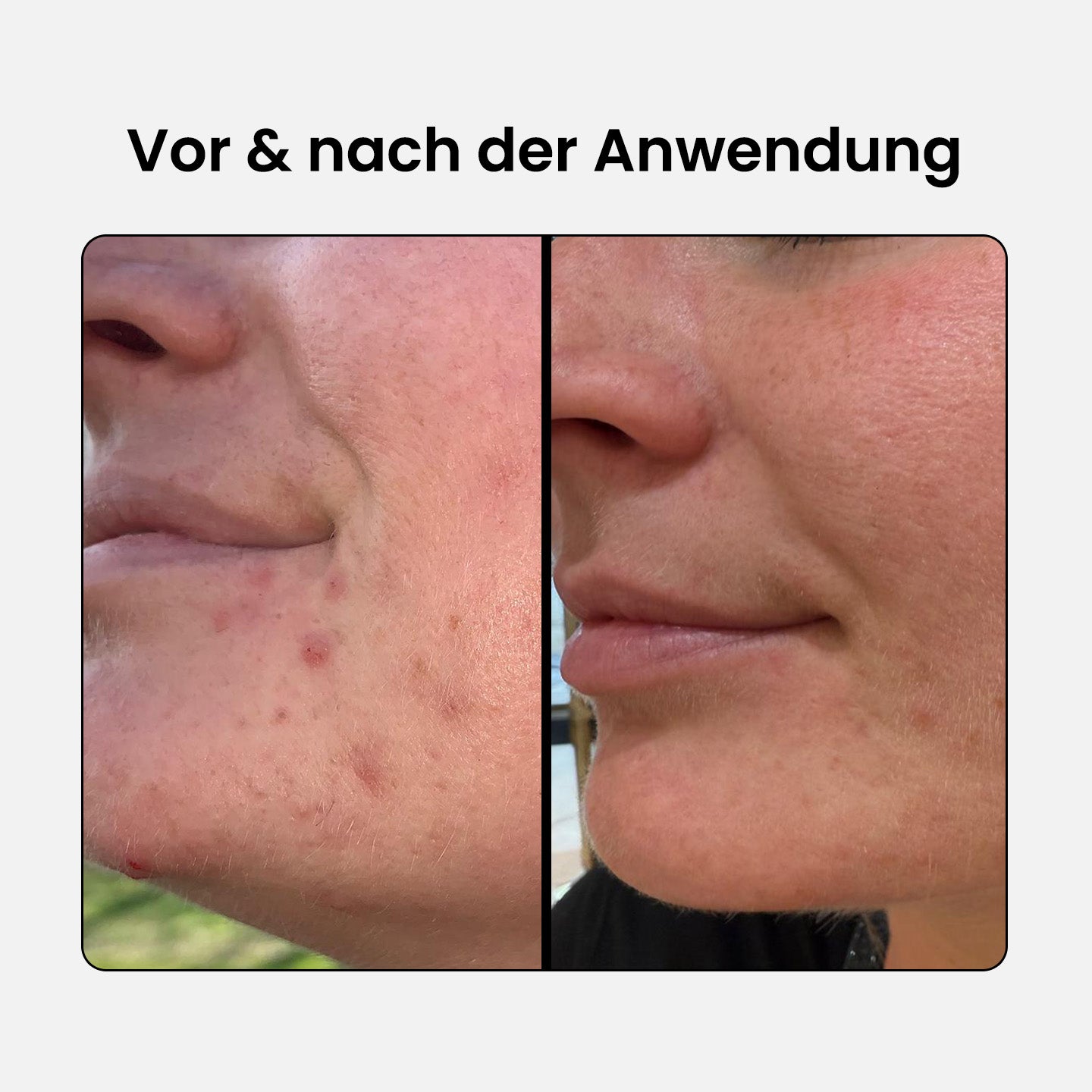 2% BHA Peeling Lotion